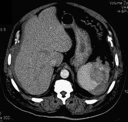 Splenic Laceration and Bleed - CTisus CT Scan