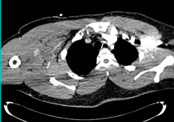 GSW Shoulder With Active Bleed and Hematoma - CTisus CT Scan