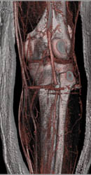 Pseudolesion Popliteal Artery Due to Bullets - CTisus CT Scan