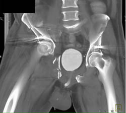 Complex Pelvic Fractures Without Bladder Injury - CTisus CT Scan