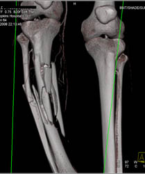 Tibial and Fibular Fractures Without Vascular Injury - CTisus CT Scan