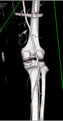 Bleed From Vessel Off SFA - CTisus CT Scan