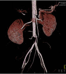 Near Occlusion of Aorta S/P Fibroid Embolization - CTisus CT Scan