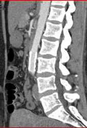 Repair of Injury in Prior Case With Stent - CTisus CT Scan