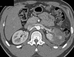 Renal Laceration and Infarction - CTisus CT Scan