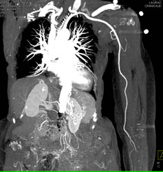 Axillary CTA Without Bleed With Bone Removal - CTisus CT Scan