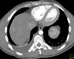 Hepatic Laceration With Bleed - CTisus CT Scan