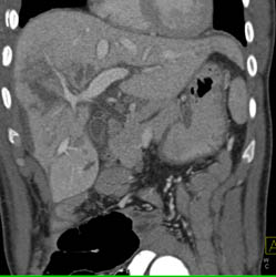 Liver Laceration With Hemoperitoneum - CTisus CT Scan