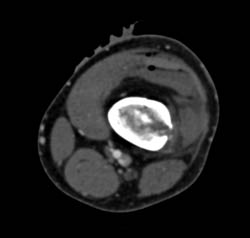 GSW Knee With Bleed - CTisus CT Scan