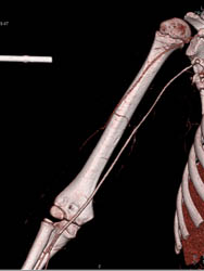 Intact Brachial Artery Without Bleed - CTisus CT Scan