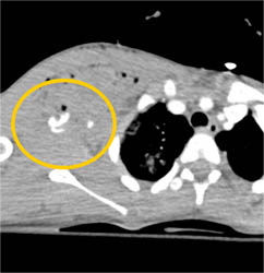 Axillary Artery Injury With Active Bleed With Bone Edit - CTisus CT Scan