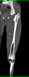 CTA Thigh S/P Trauma Without Vascular Injury - CTisus CT Scan