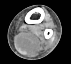 Myositis S/P Trauma - CTisus CT Scan