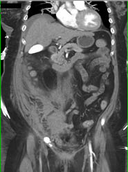 SFA Pseudoaneurysm With Bleed Tracking to RLQ - CTisus CT Scan