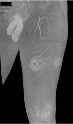 GSW With Muscle and Soft Tissue Injury - CTisus CT Scan