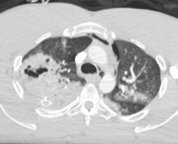 Pulmonary Contusion - CTisus CT Scan