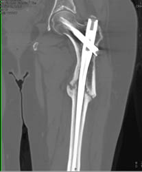 Nonunion Femur - CTisus CT Scan