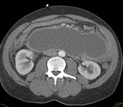 Pseudocyst S/P Trauma - CTisus CT Scan