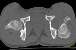 Left Hip Dislocation - CTisus CT Scan