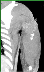 Active Bleed Arm S/P Trauma - CTisus CT Scan