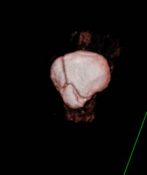 Patellar Fracture - CTisus CT Scan