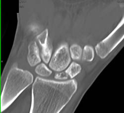 Scaphiod Nonunion - CTisus CT Scan