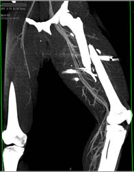 Femur Fracture S/P GSW - CTisus CT Scan