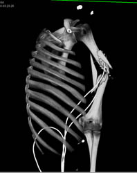 Humerus Fracture S/P GSW - CTisus CT Scan