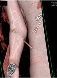 Stab Wound With Rod Still In - CTisus CT Scan