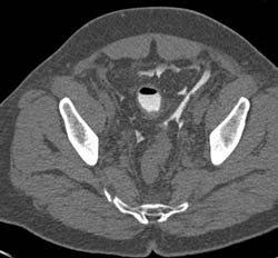 Bladder Extravasation of Contrast - CTisus CT Scan