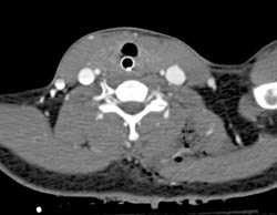 GSW Chest Wall and Shoulder With Active Bleed - CTisus CT Scan