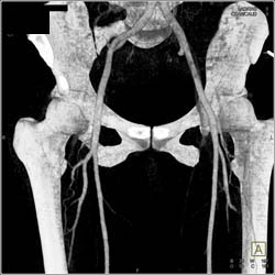 Trauma Without Vascular Injury - CTisus CT Scan