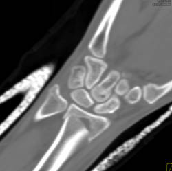 Distal Radius Fracture and Subtle Scaphoid Fracture - CTisus CT Scan