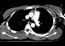 GSW With Hepatic Laceration - CTisus CT Scan