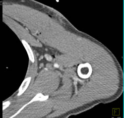 Stab Wound Axilla Without Vascular Injury - CTisus CT Scan