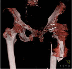 Fracture Femur at Lower Aspect of Total Hip Replacement (THR) - CTisus CT Scan