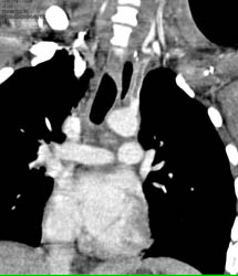 Trauma With Occlusion of Subclavian Artery - CTisus CT Scan