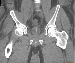 Pelvic Trauma With Bladder Injury and Leak in CT Cystography - CTisus CT Scan