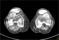 Trauma With Popliteal Artery Aneurysm - CTisus CT Scan