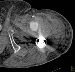 Thigh Trauma With Pseudoaneurysm and Bleed - CTisus CT Scan