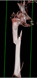 Total Hip Replacement (THR) With Femur Fracture at Lower Aspect of Prosthesis - CTisus CT Scan