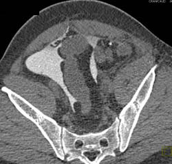 Bladder Trauma With Leak - CTisus CT Scan