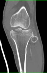 Tibial Plateau Fracture - CTisus CT Scan