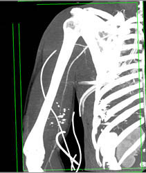 Trauma to Arm- GSW- With Spasm of Brachial Artery - CTisus CT Scan