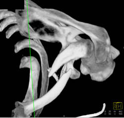 Clavicle Fracture - CTisus CT Scan