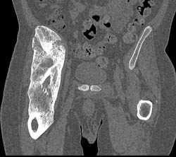 Myositis Ossificans - CTisus CT Scan