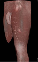 GSW to Thigh Without Vascular Injury - CTisus CT Scan