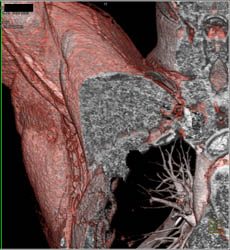 Patent Axillary Artery S/P Trauma - CTisus CT Scan