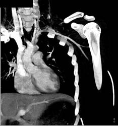 GSW Axilla With Bleed From Axillary Artery- See Full Sequence - CTisus CT Scan