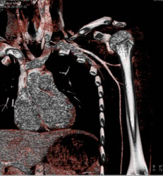 No Evidence of Axillary Artery Bleed- See Full Sequence - CTisus CT Scan